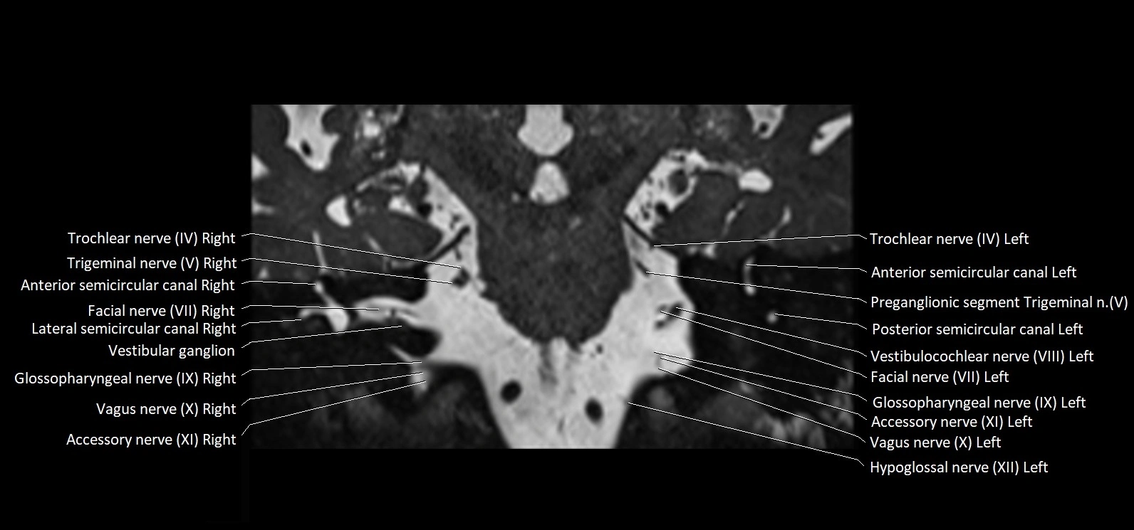Cranial nerve cross sectional anatomy coronal 3T MRI image 42.webp